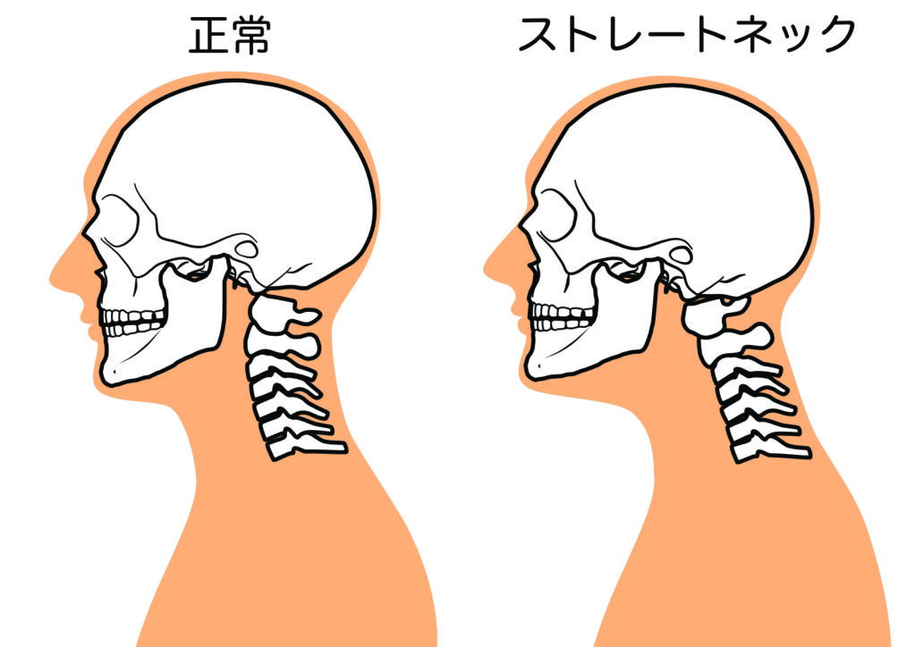 舌の位置が崩れると起こる姿勢の乱れ